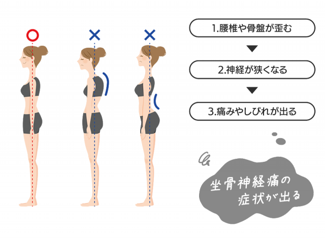 坐骨神経痛の症状が出るまでの流れ